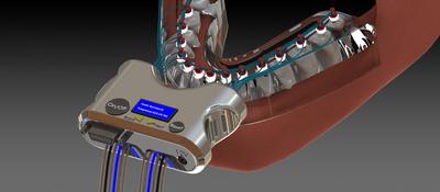 detecting tooth decay using piezo vibration